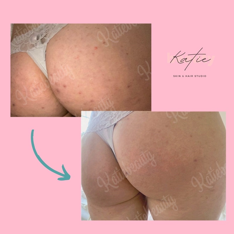 COMBO Cải thiện thâm mông, body - BODY ACNES COMBO | KATIEBEAUTY