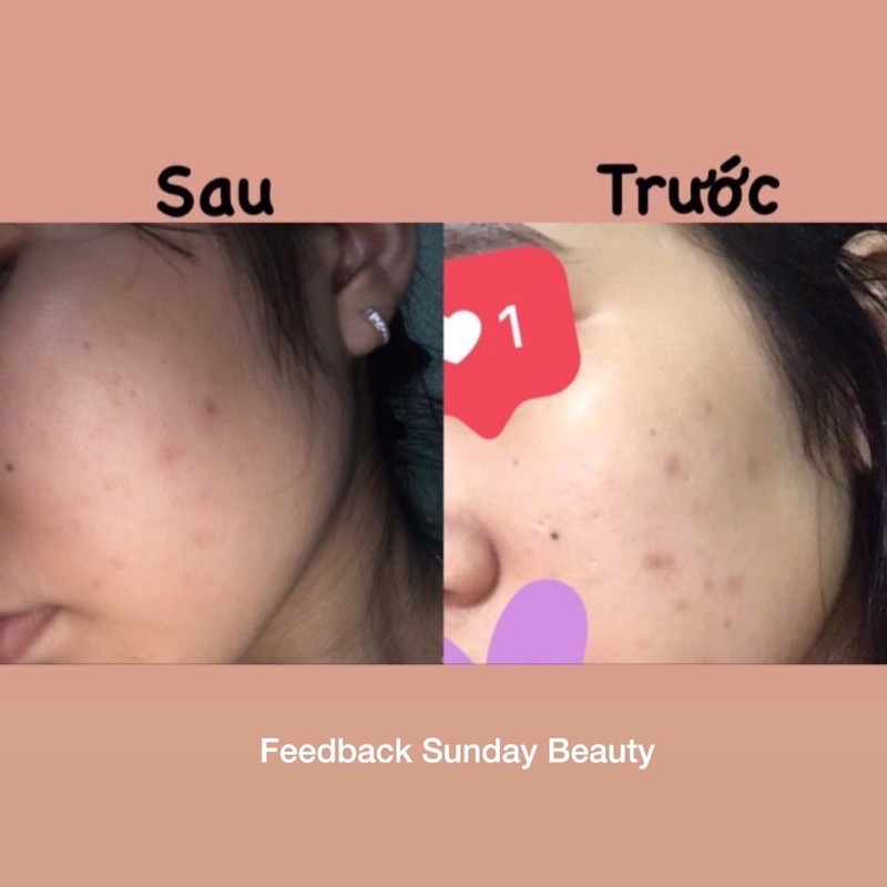 Combo kem thâm & mụn handmade Sunday Beauty