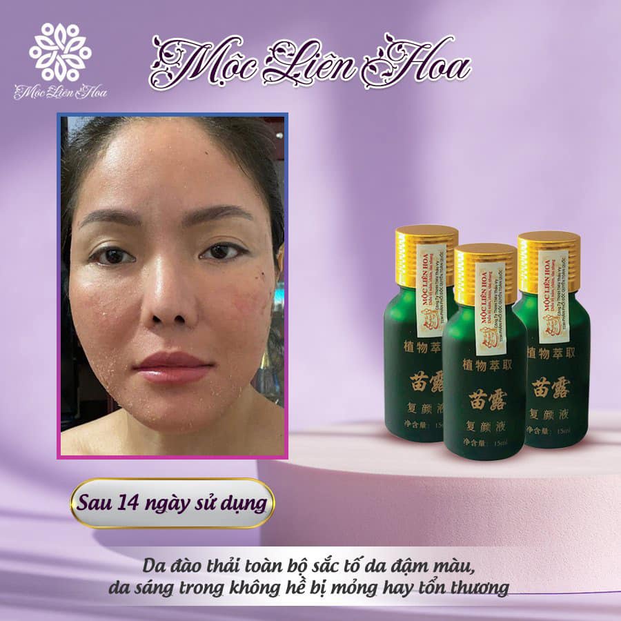 Mộc Liên Hoa Ultra Spot - Mờ nám, tàn nhang chính hãng - Huda shop