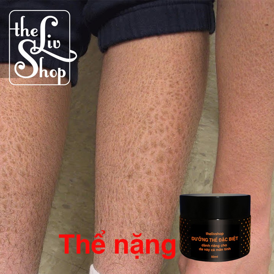 Da vảy cá, da rắn -  Kem dưỡng da đặc biệt homemade