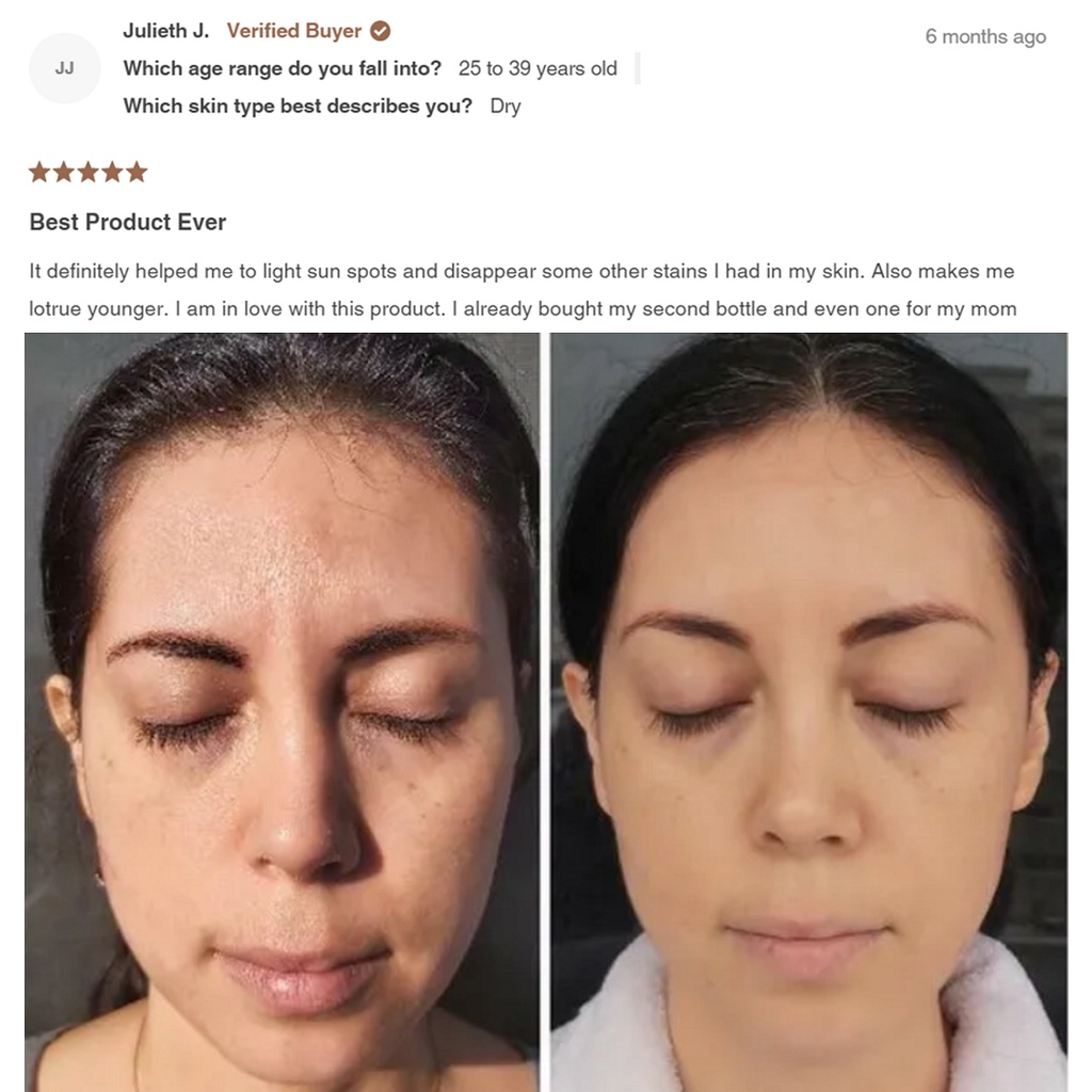 4% Hydroquinone 20% Vitamin C giảm nám thâm xạm cho da bật tone trắng sáng tươi trẻ Simplicity