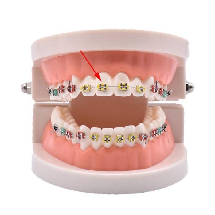 [Hàng mới về] Bộ 40 dây buộc niềng răng và súng bắn dây buộc dây niềng răng hỗ trợ chỉnh hình nha khoa (có bán lẻ)
