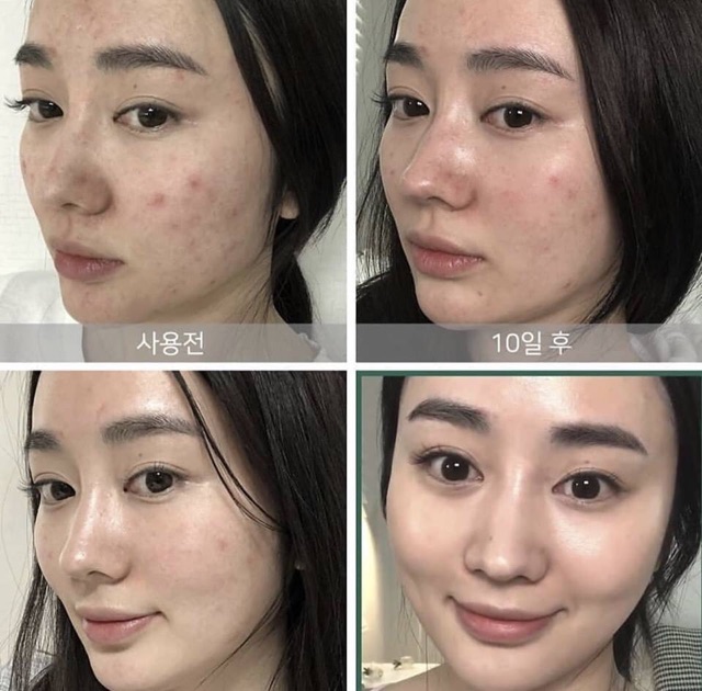 Set dưỡng da mụn SOME BY MI AHA-BHA-PHA 30 DAYS MIRACLE TRAVEL KIT 3 món - 3 items | BigBuy360 - bigbuy360.vn