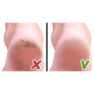 Kem Gót Sen (dưỡng ẩm, trị nứt nẻ gót chân) - 20g
