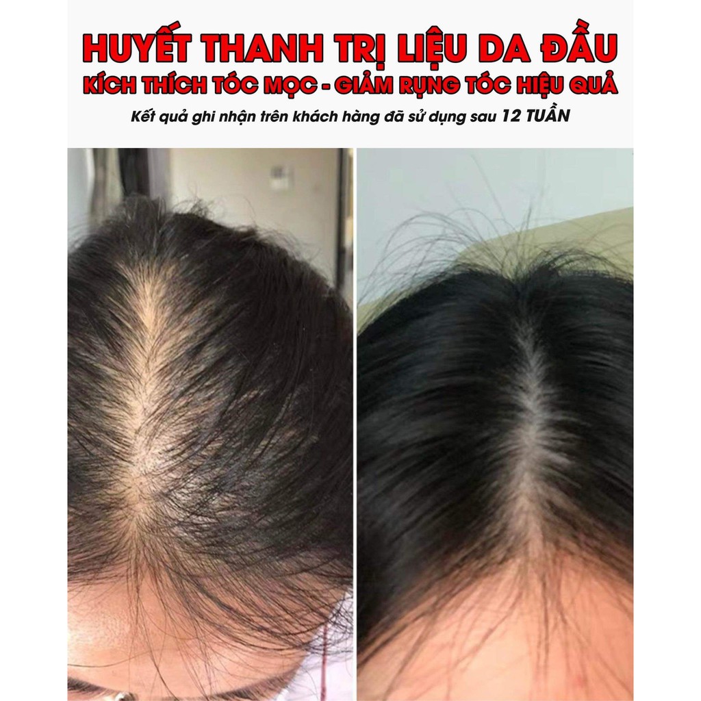 [Dùng Thử Lọ 5ml] Hỗ Trợ Kích Mọc Tóc Nhanh Huyết thanh Serum Mọc Tóc Weilaiya Chính Hãng Cam Kết Hiệu Quả Sau 12 Tuần | BigBuy360 - bigbuy360.vn