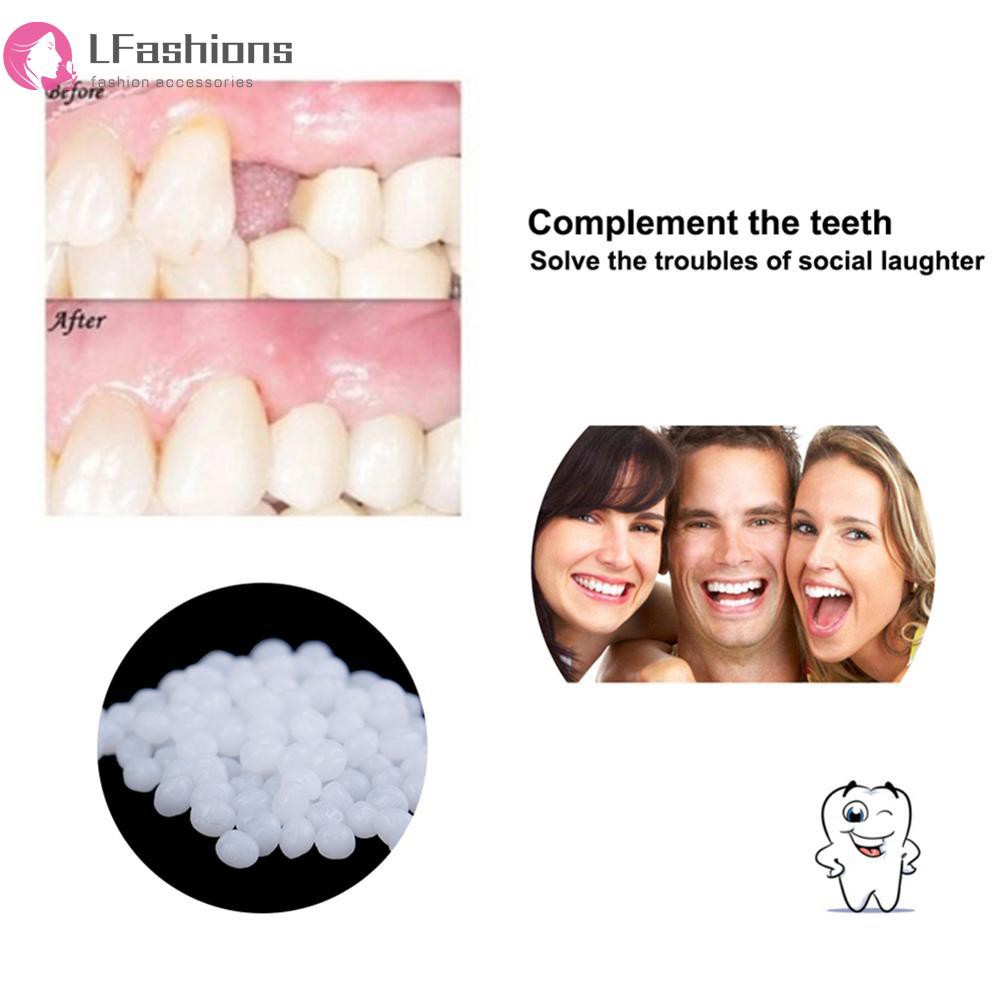 Keo trám khe răng 10/100g