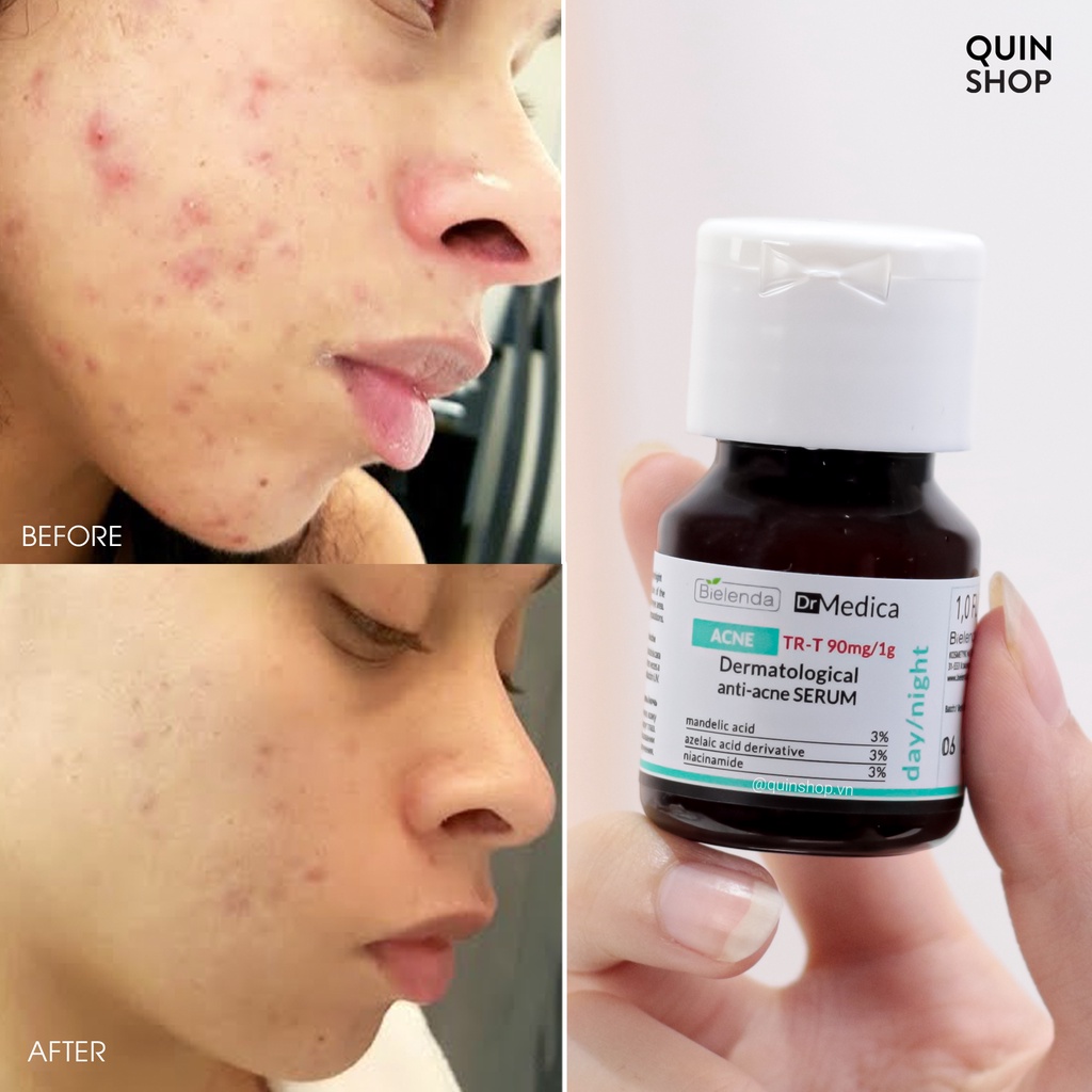 Tinh Chất, Kem Dưỡng Giảm Mụn, Mờ Thâm, Dịu Da Bielenda Dr Medica Acne, Capillaries Dermatological Serum - Cream