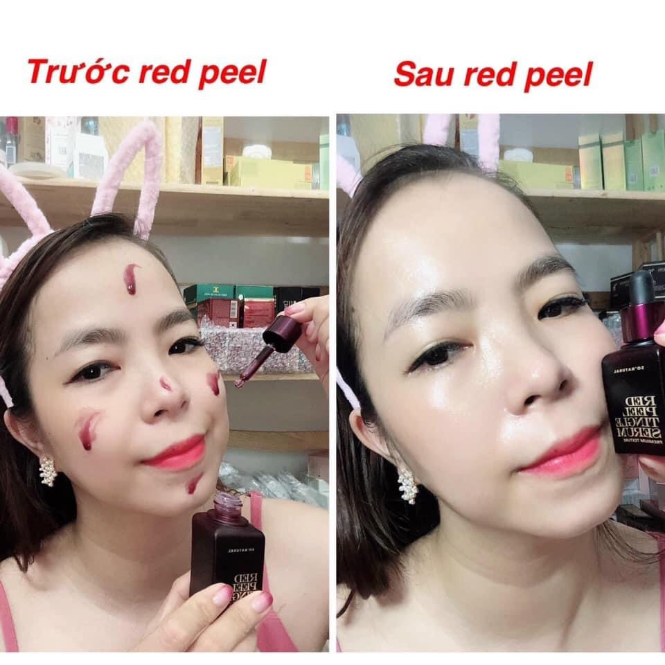 [Bản cao cấp] Serum peel da, thay da sinh học RED PEEL Premium, So Natural Korea