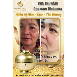 MỜ NÁM SẠM TÀN NHANG CAO NÁM MELASMA