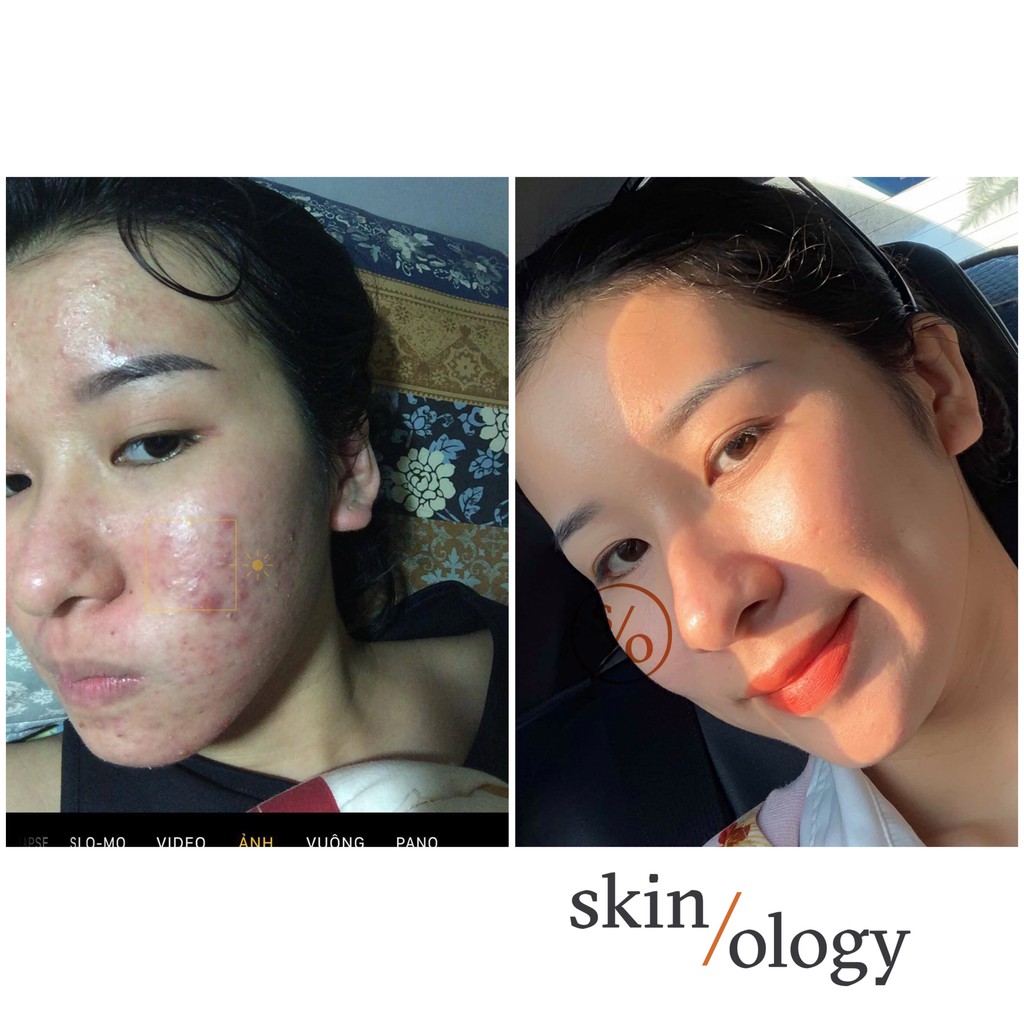 GIẢI PHÁP NGỪA MỤN NÁM SẸO RỖ TÁI TẠO LÀN DA MỚI SKIN RENEWAL SOLUTION BẰNG THẢO DƯỢC DÀNH CHO MỌI LOẠI DA | BigBuy360 - bigbuy360.vn