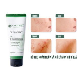 Combo chăm sóc da mụn Caryophy Portulaca (sữa rửa mặt 150ml toner 300ml serum 10ml)