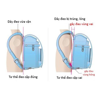 Cặp chống g.ù lưng Nhật Bản