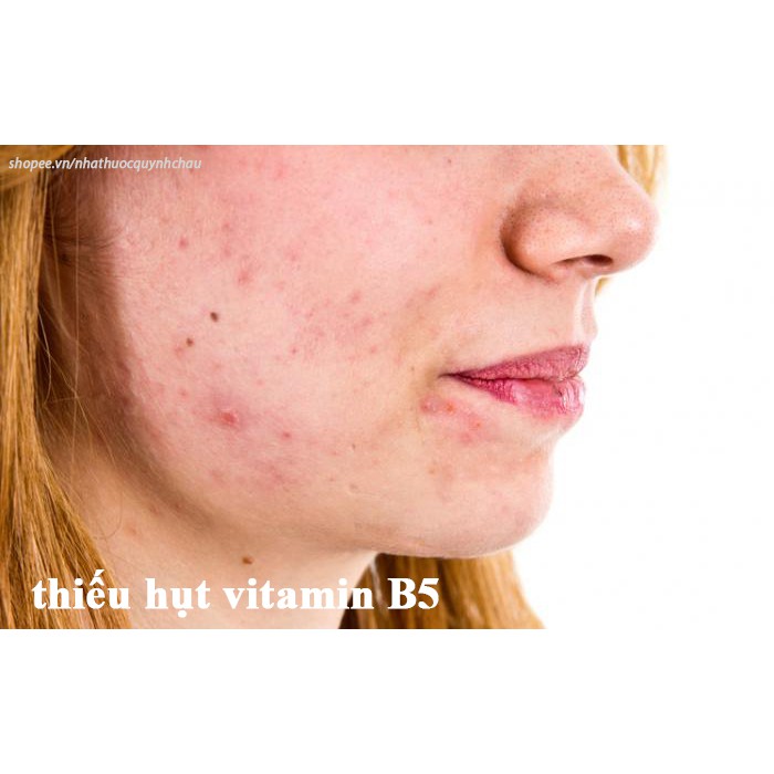 Viên uống BEDIPANTEN 100MG  giảm nhờn da, mụn, rụng gãy tóc