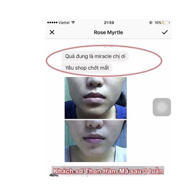 Tinh chất thu xương hàm má Miracle - Pháp, hiệu quả chỉ sau 14 ngày (10ml)