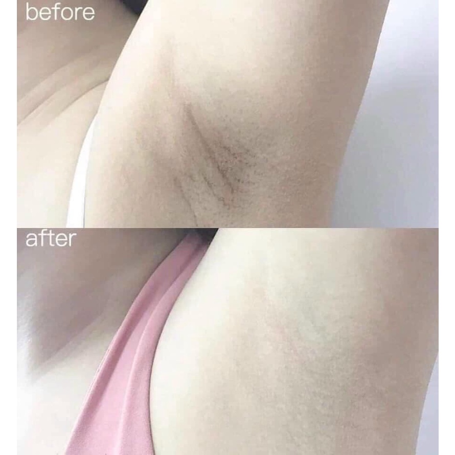 Lăn khử mùi thanh lăn và xịt khử mùi chống vàng áo, khử mùi hôi nách, chống thâm nách Snoppy S Carat Medicated Kose Nhật