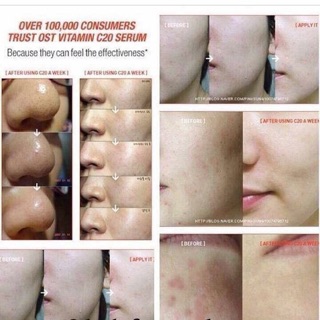 SERUM C21.5 OST Advanced- THÂM- MỤN