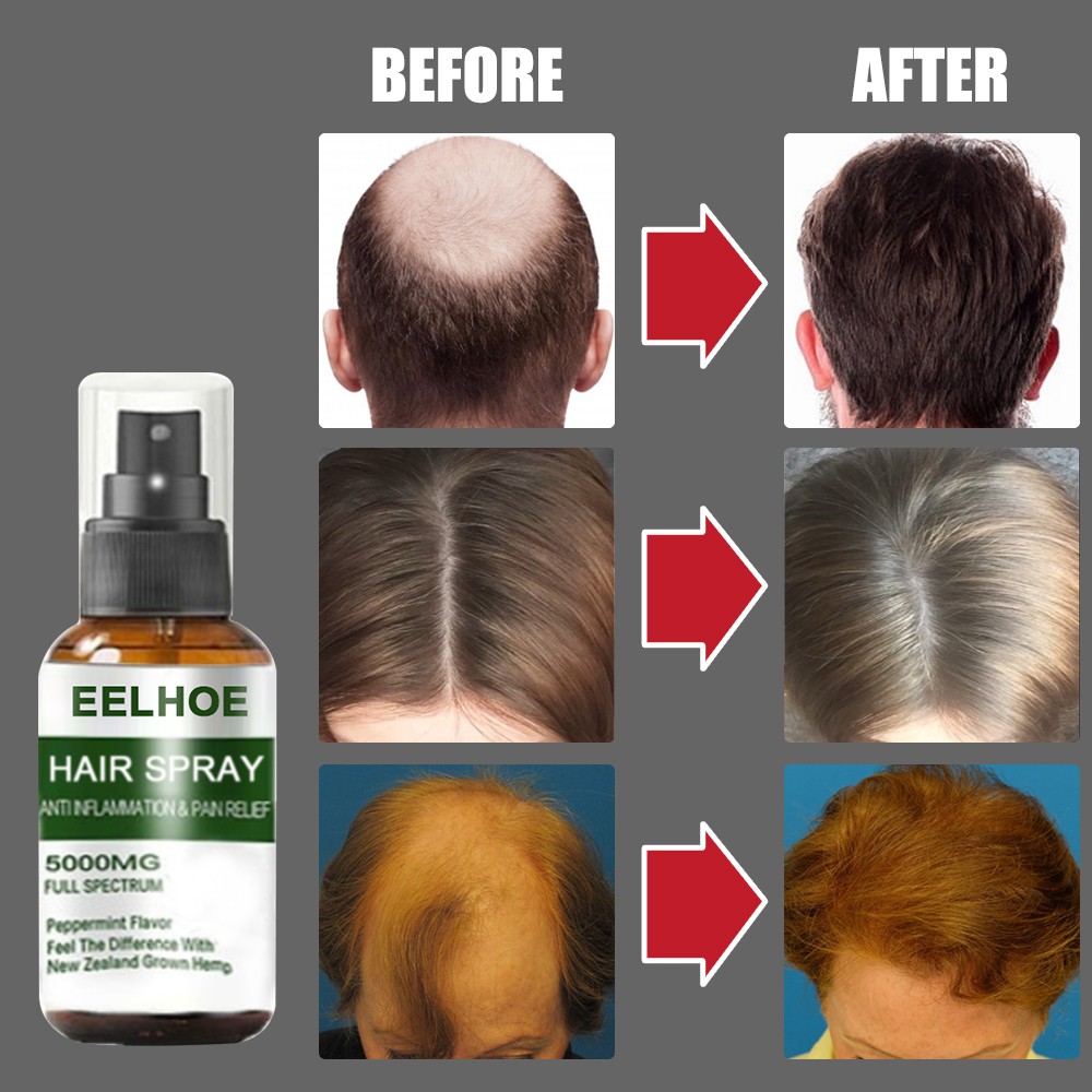 (Hàng Mới Về) Chai Xịt Kích Thích Mọc Tóc Và Trị Hói Đầu Hiệu Quả | BigBuy360 - bigbuy360.vn