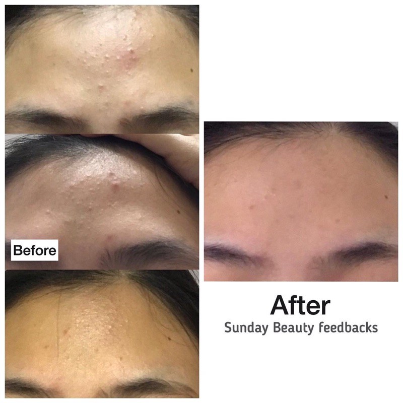 Combo kem thâm & mụn handmade Sunday Beauty