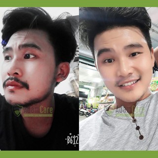 Combo 2 chai minoxidil 5% dạng Foam mọc râu tóc
