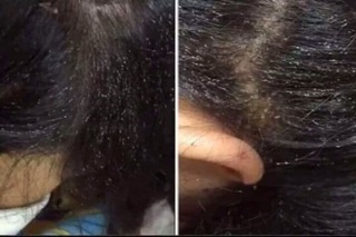 Dầu gội trị nấm trị chấy