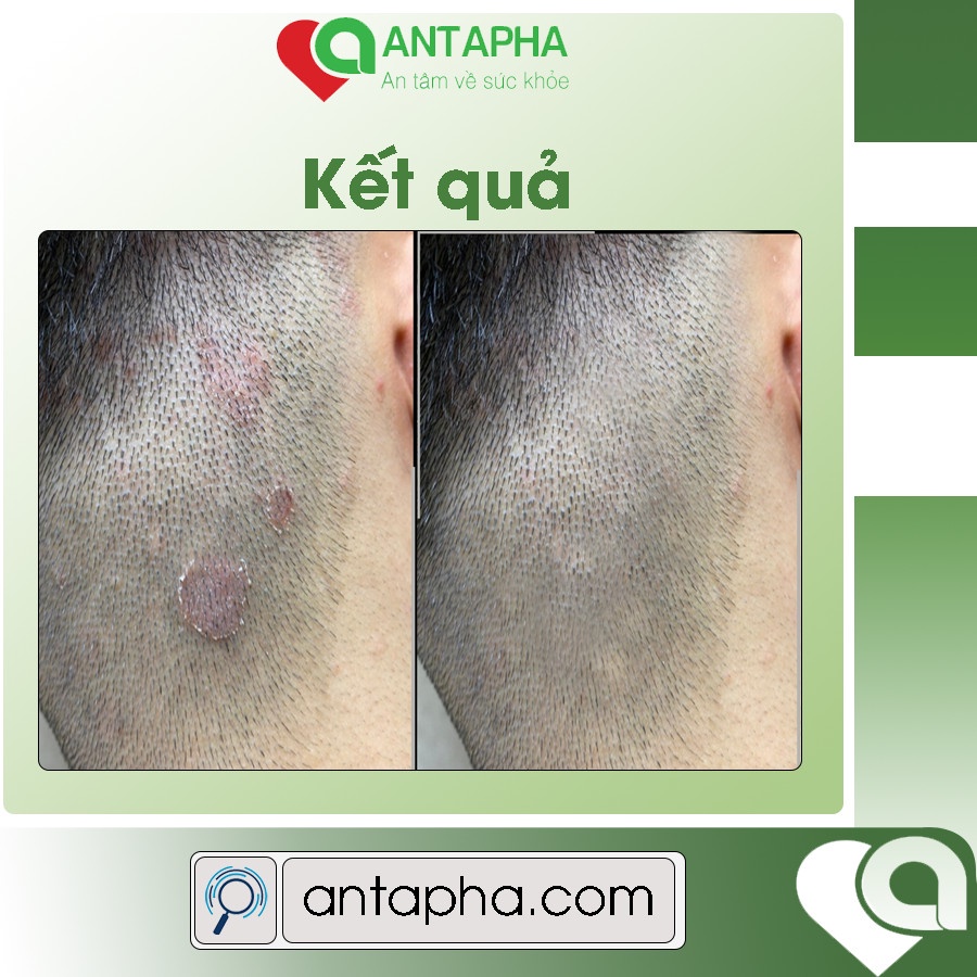 Nấm da đầu, sạch gàu ngứa loại bỏ tận gốc gàu nấm da đầu lâu năm hiệu quả không tái phát, ngăn rụng tóc serum Trinada