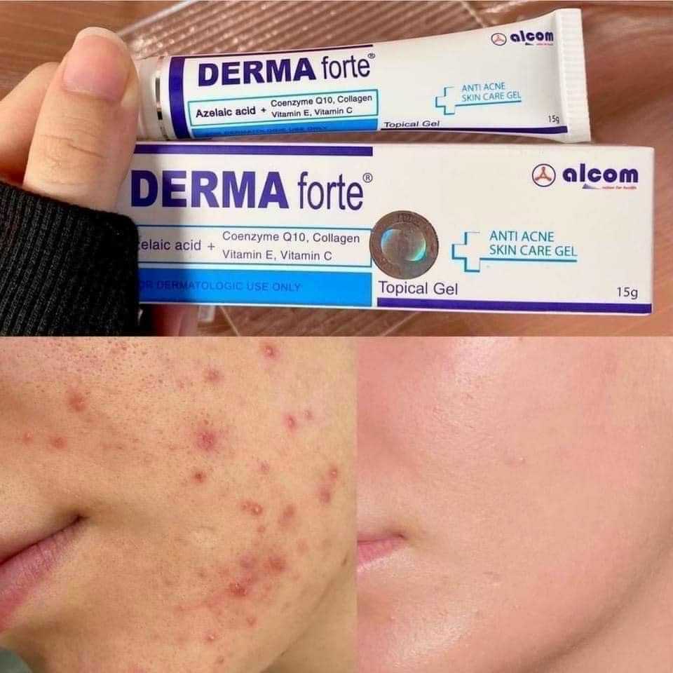 [TẶNG MÓC TREO TƯỜNG CUTE] Derma Forte Gel 15g - Mẫu Mới Advanced - Giảm Mụn Trứng Cá, Ngừa Thâm, Mờ Sẹo, Dưỡng Da