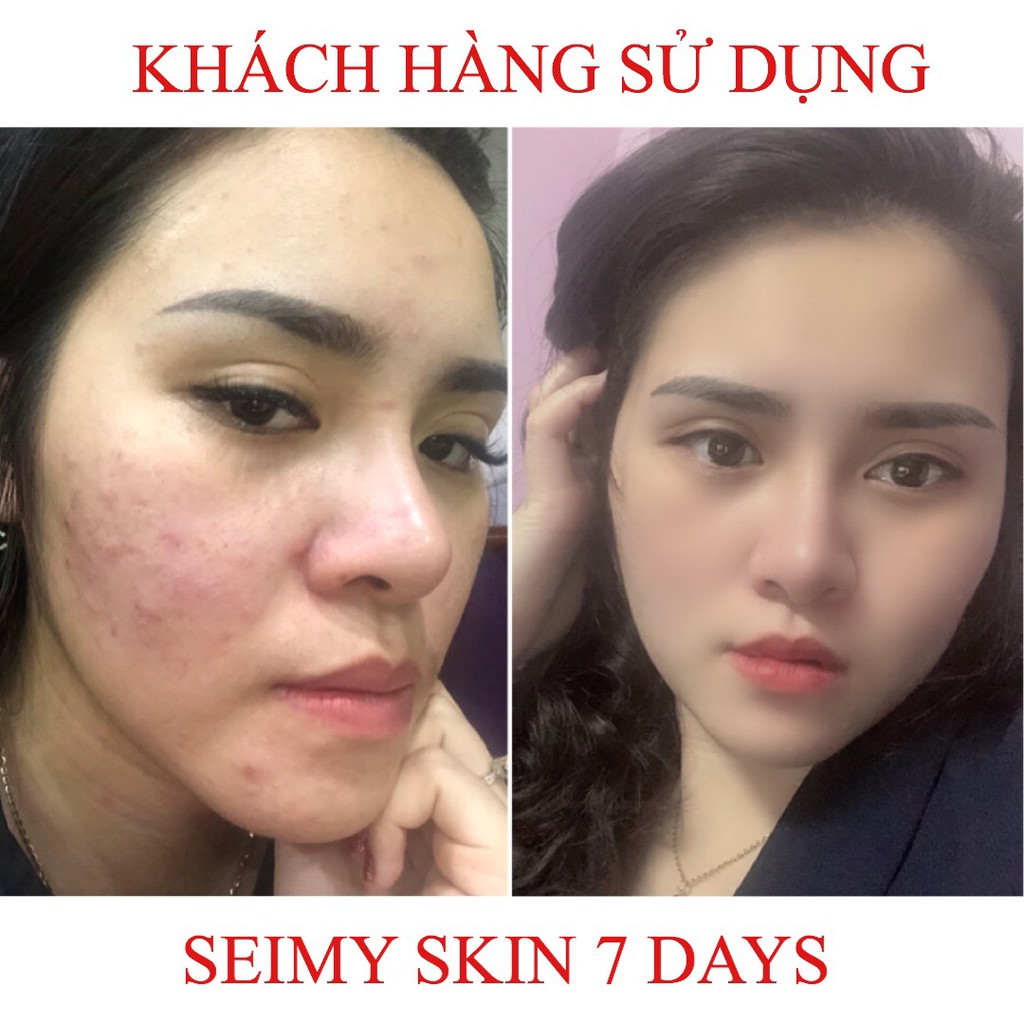 Serum giảm mụn thâm rỗ Seimy - Skin 7 Days - Công dụng 5 trong 1 hiệu quả sau 7-14 ngày - Mờ thâm, mụn, mụn ẩn