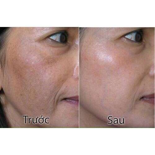 Serum nám Hoa Anh Đào 30ml