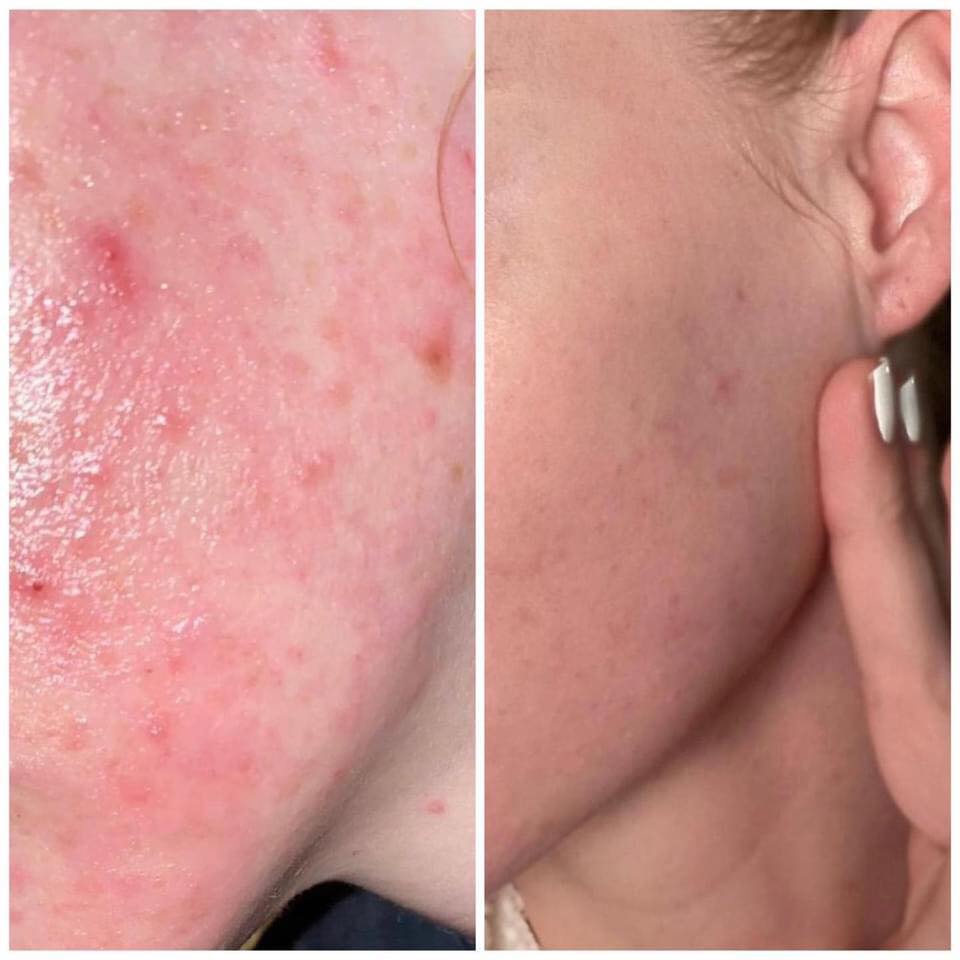 Toner SVR Sebiaclear Micro Peel Nước Cân Bằng thanh lọc, tẩy tế bào chết cho da dầu mụn 150ml