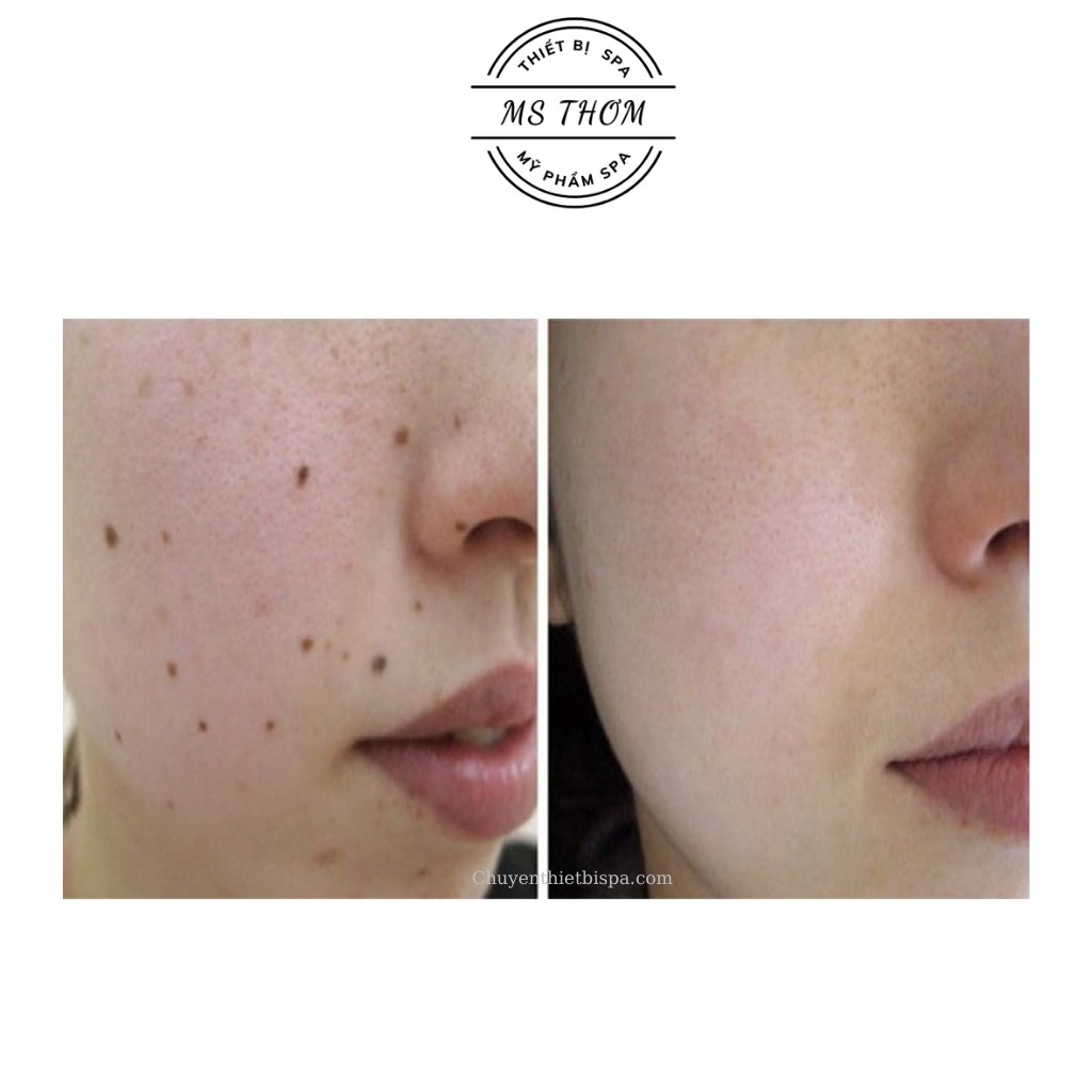 Máy đốt mụn ruồi, mụn thịt, đôm nám, trị hôi nách M370 - chuyên dùng trong Spa/TMV BH chính hãng 12 tháng