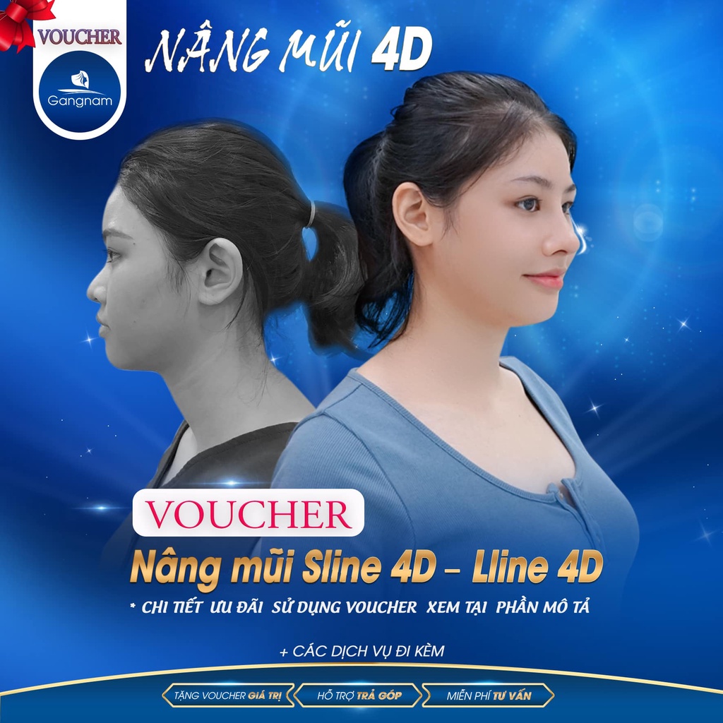 Nâng Mũi S-Line / L-Line: 3D,4D,6D | Thẩm Mỹ Viện Gangnam