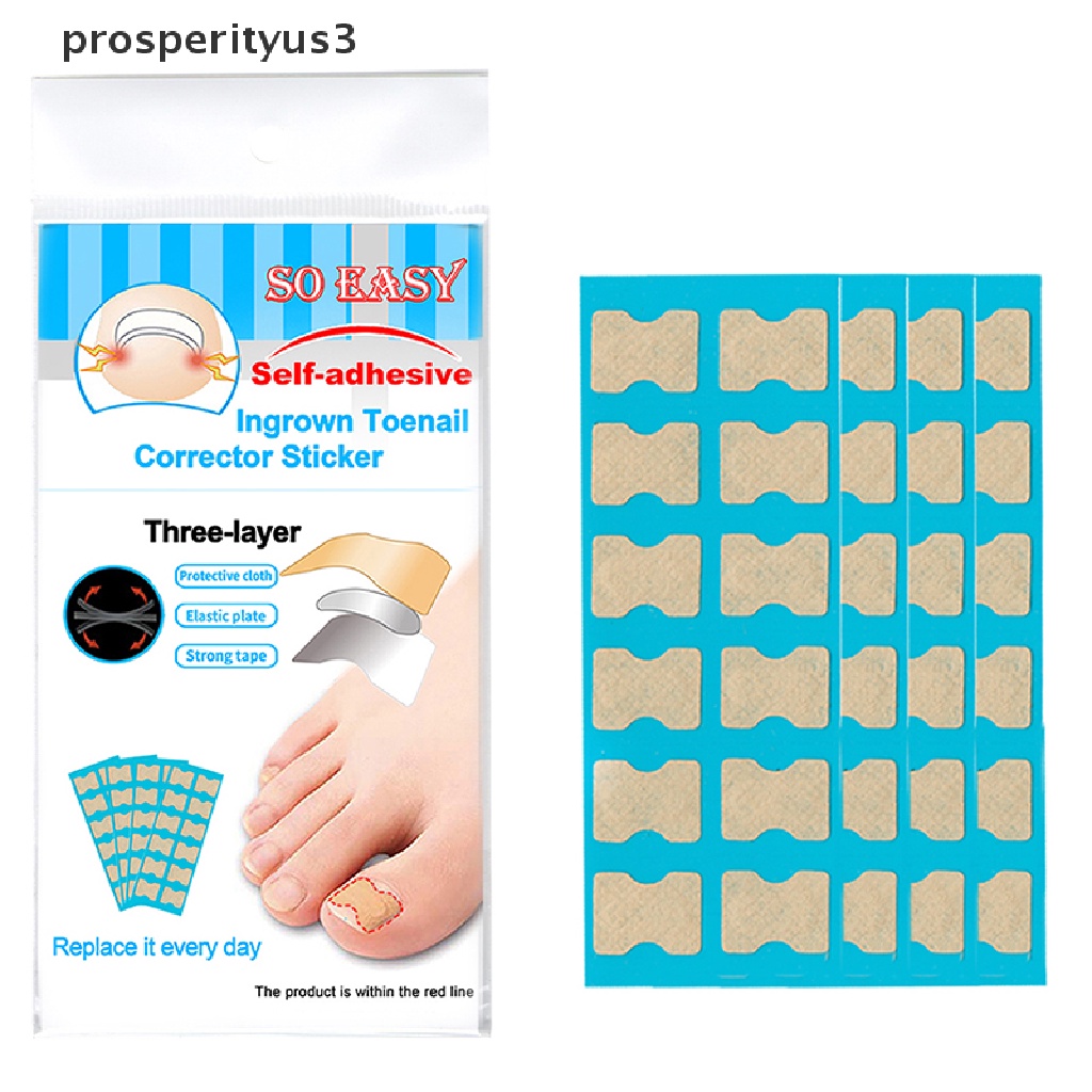 [prosperityus3] Ingrown Toenail Correction Tool Toe Nail Treatment Elastic Patch Sticker Clip [new]