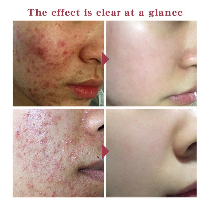 Centella Asiatica Essence Hydrating Control Oil Face Skin Care | BigBuy360 - bigbuy360.vn