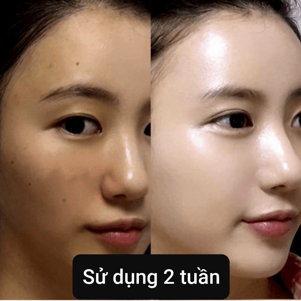 Combo Tri Nam, Dưỡng Trắng Da V9Queen