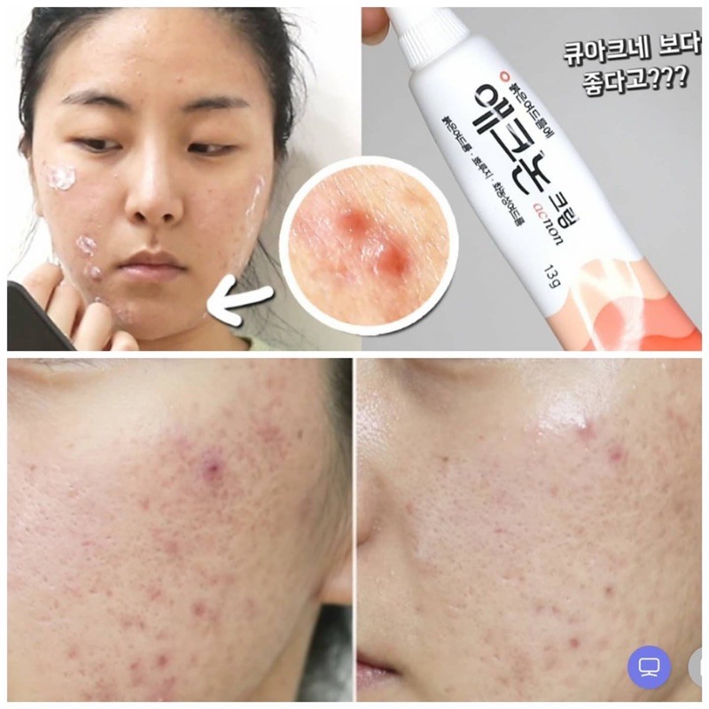 Kem diệt mụn ACNON CREAM