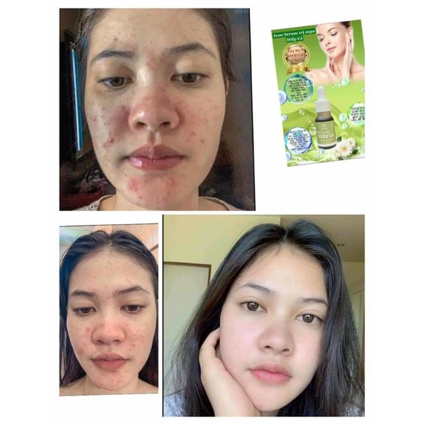 Serum Diếp Cá GIẢM MỤN, GIẢM THÂM, SE KHÍT LỖ CHÂN LÔNG, SÁNG DA - Serum Diếp Cá IGREEN | BigBuy360 - bigbuy360.vn