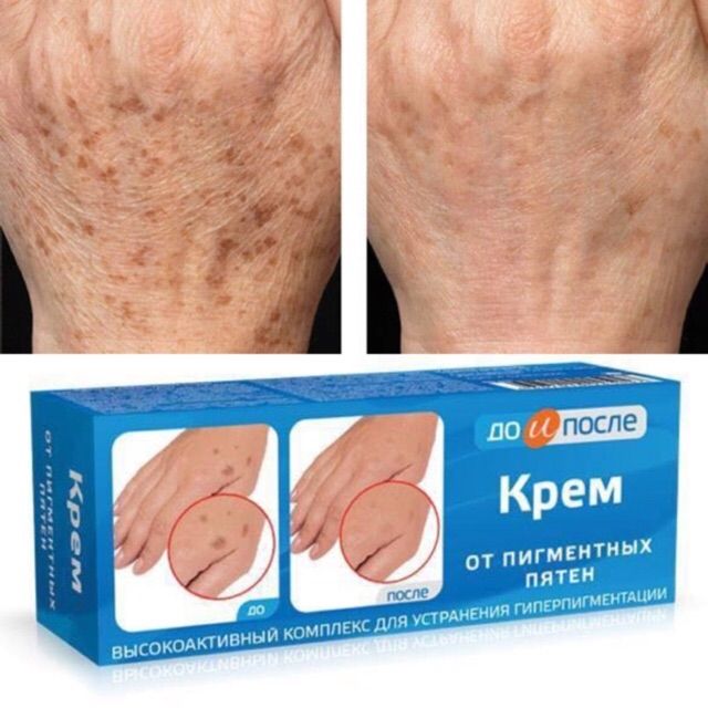 Kem loại bỏ đồi môi kpem nga_kem loại bỏ đồi môi tay chân