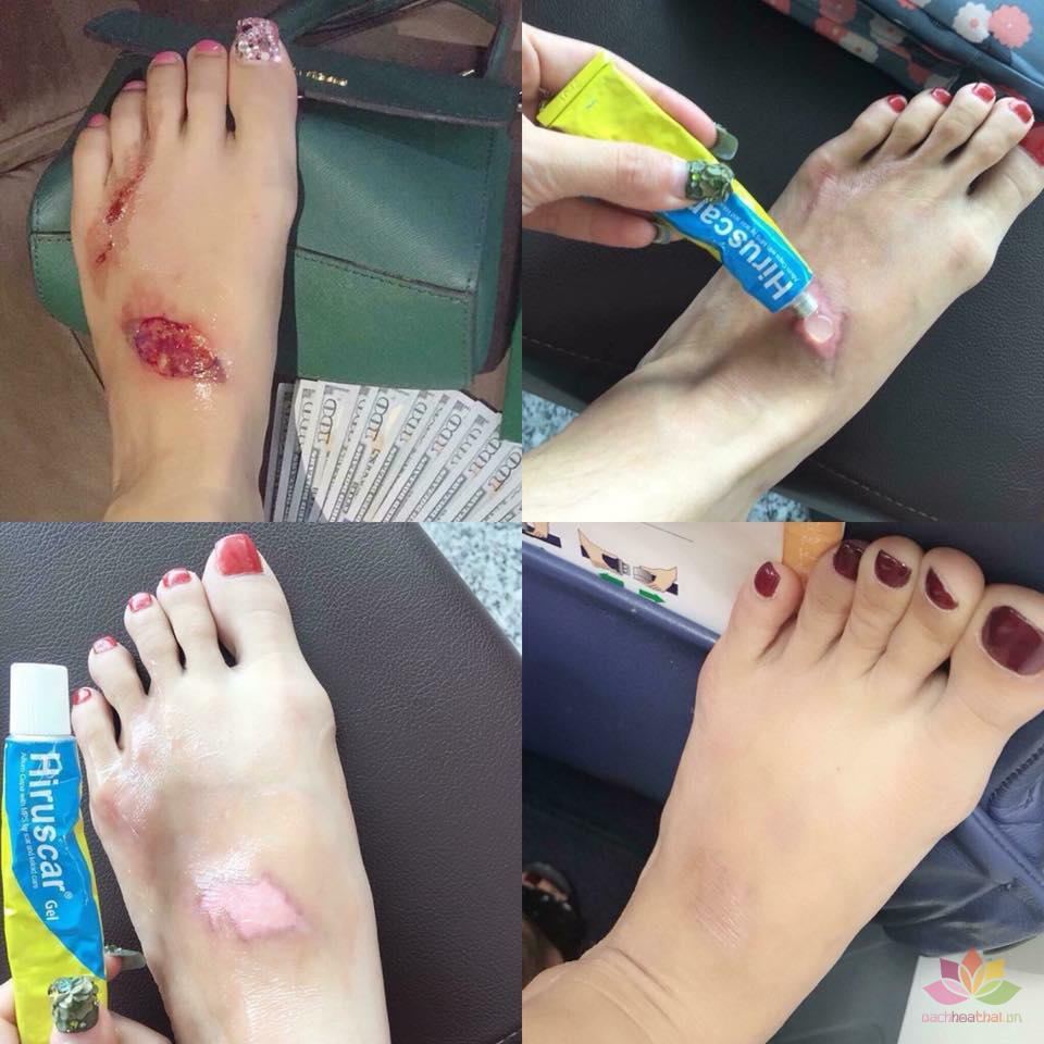 Gel làm mờ şẹo Hirucas -7g (Thailand)