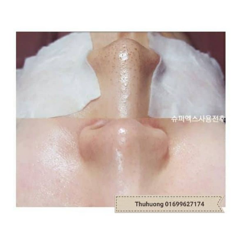 Ủ mụn đầu đen đầu trắng Mĩ SUPER X LOTION 100ml