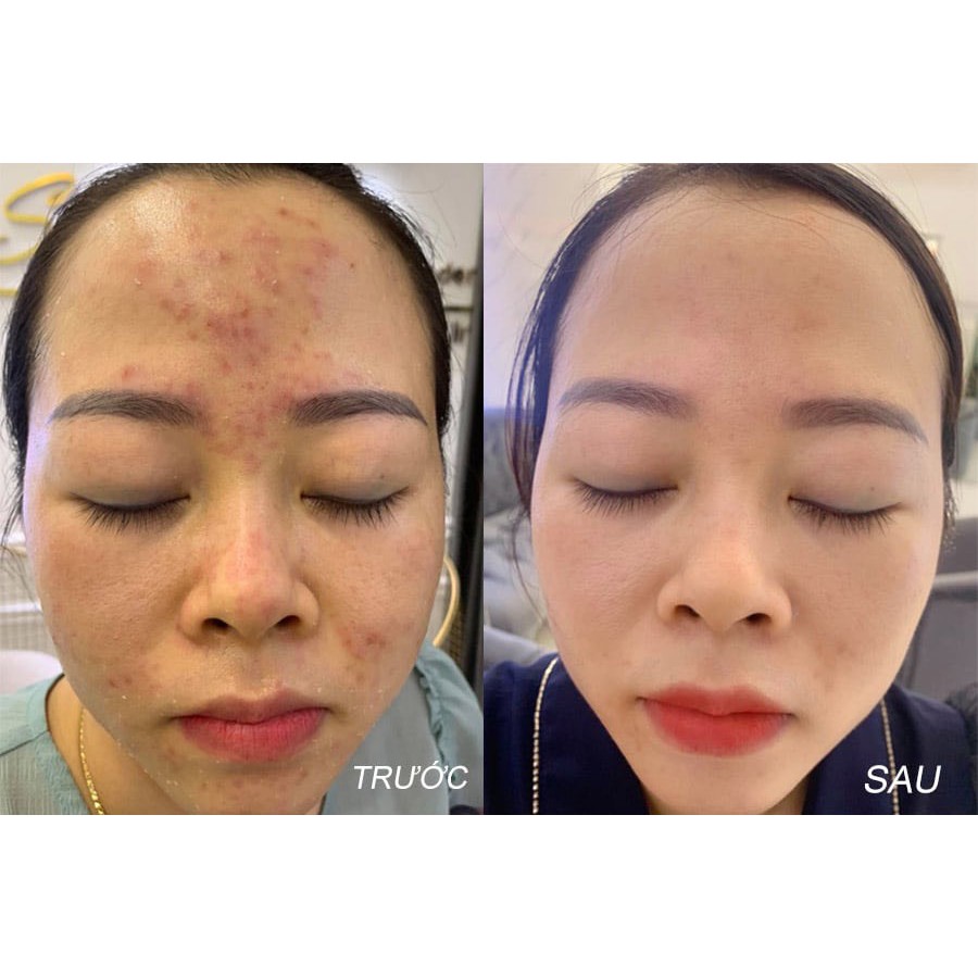 Kem Ngừa Mụn Siêu Tốc Độ Acosmetics, Tặng 1 Kem xóa thâm - 50g | BigBuy360 - bigbuy360.vn