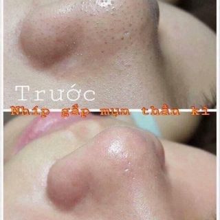 NHÍP GẮP MỤN THẦN THÁNH
