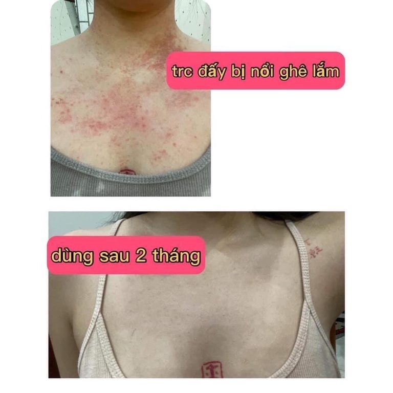 Serum sạch mụn lưng ngăn ngừa các loại mụn sưng đỏ, làm dịu da ở các vị trí lưng, ngực và body... hiệu quả 30ml