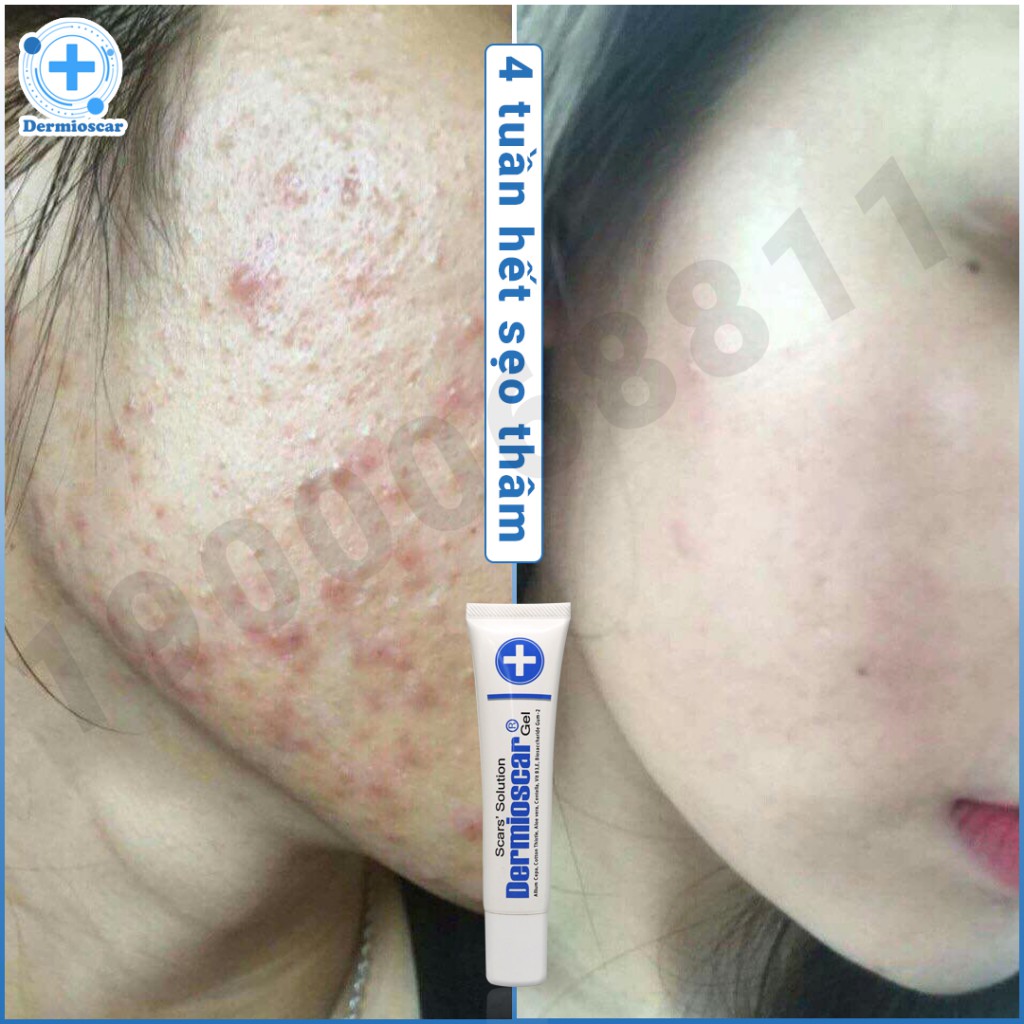 100% chính hãng - Kem mờ sẹo Dermioscar 20g - Thái Lan | BigBuy360 - bigbuy360.vn