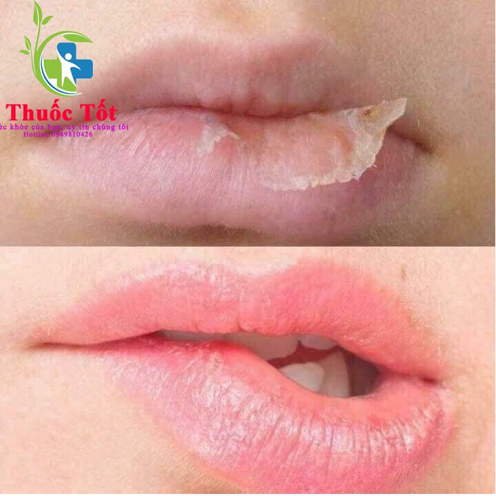 Dưỡng môi Vaselin Học viện Quân Y