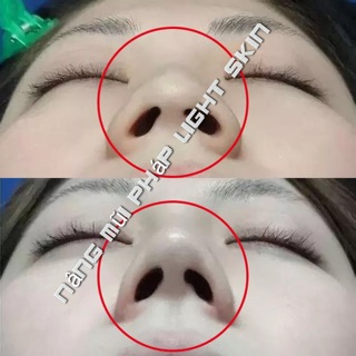 Serum nâng mũi Pháp