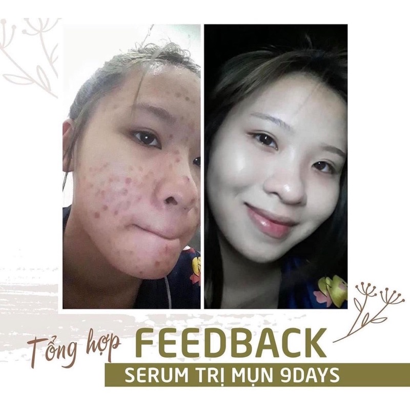 Serum ngăn ngừa mụn và thâm , se khít lỗ chân lông giúp da sáng mịn 9DAYS SKIN 10ml