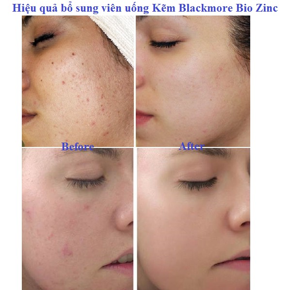 KẼM BLACKMORE BIO ZINC 84/168 VIÊN