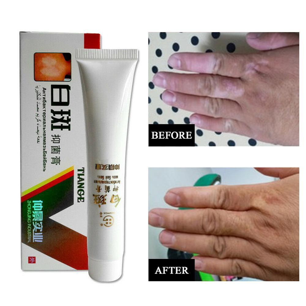 Kem dưỡng trắng da cao cấp Vitiligo 30g