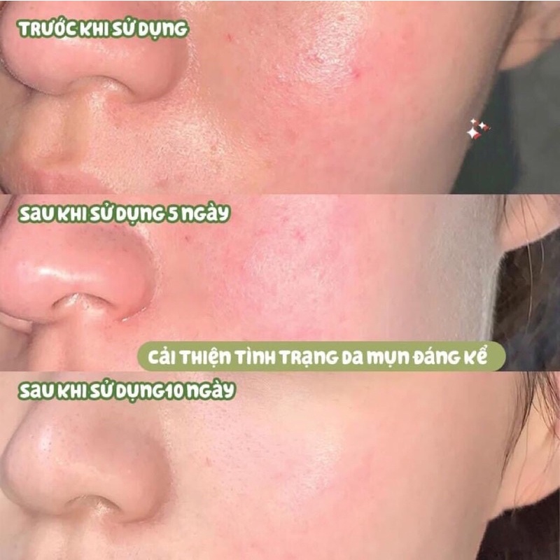 [Chính hãng] Nước hoa hồng Simple dành cho da dầu mụn
