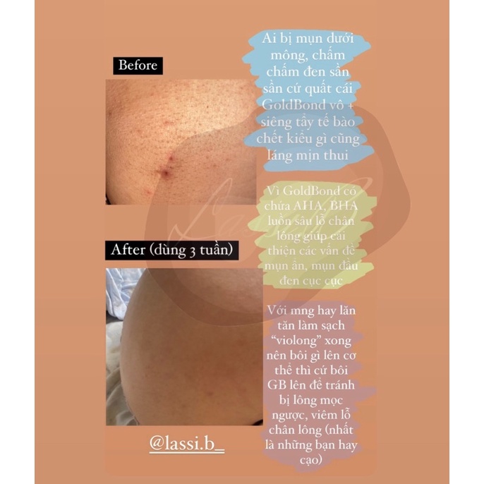 Kem dưỡng Gold Bond Rough&Bumpy Skin dành cho da sần sùi, da gà, viêm nang lông